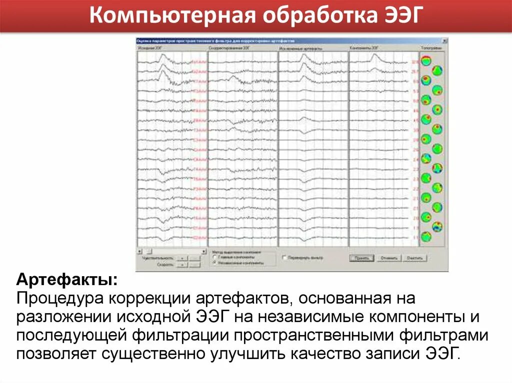 Запись на ээг. Артефакты ЭЭГ. Электроэнцефалография аппарат. Компоненты ЭЭГ. Электроэнцефалография с компьютерной обработкой что это.