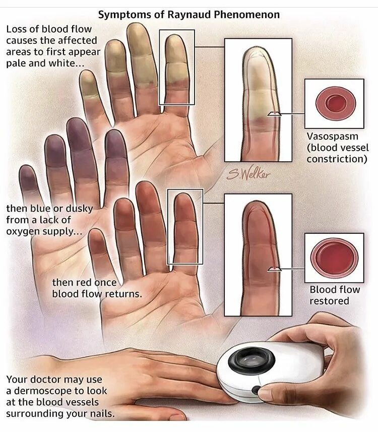 Феномен Рейно и синдром Рейно. Спазм периферических сосудов синдром Рейно. Синдром Рейно кисти рук. Потом ягодка начнет увеличиваться багроветь затем синеть