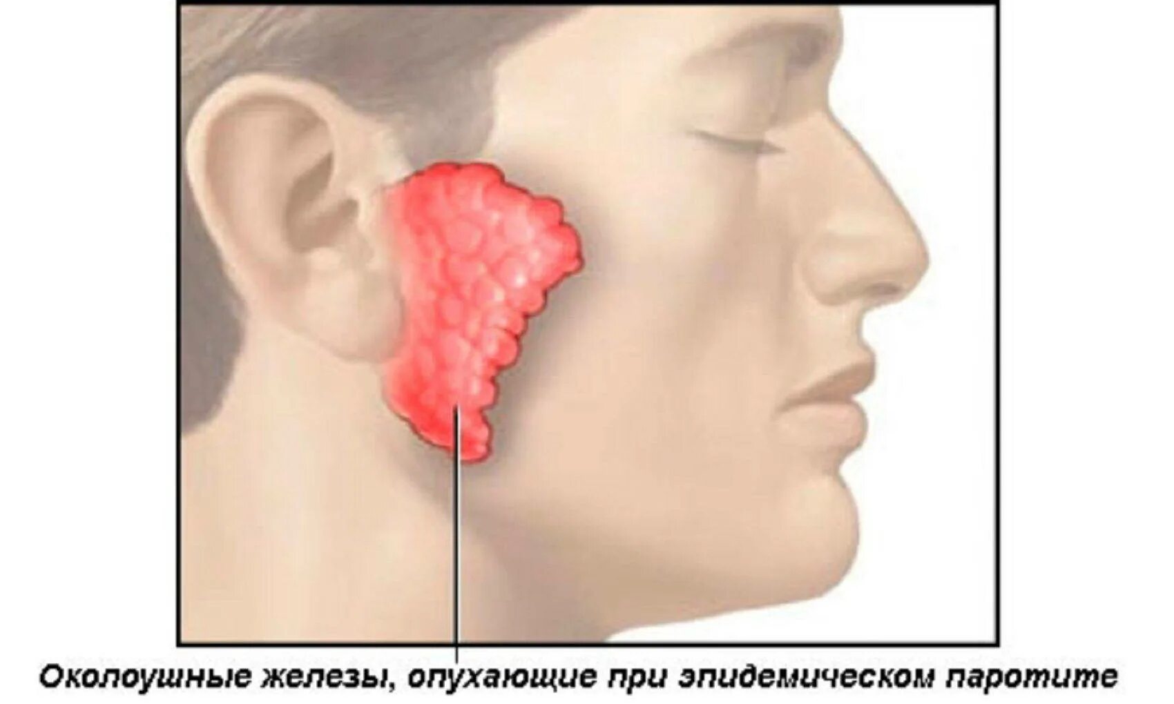 Воспаление околоушной слюнной железы. Калькулезное воспаление слюнных желез. Сиалоаденит слюнной железы. Воспаление протока околоушной железы.