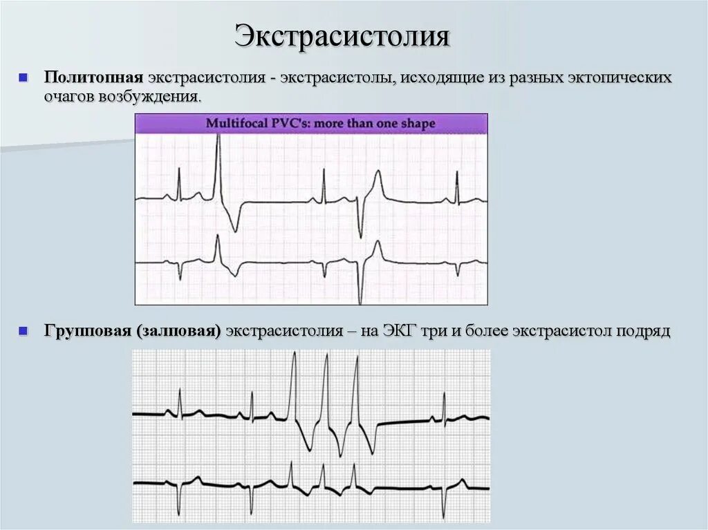 Политопные и монотопные экстрасистолы. Желудочковые мономорфные экстрасистолы ЭКГ. Политопные мономорфные желудочковые экстрасистолы. Наджелудочковая экстрасистолия на ЭКГ. Политопные экстрасистолы