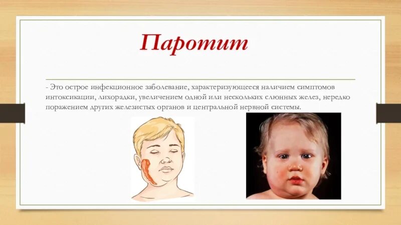 Паратит что это. Воспаление слюнной железы паротит. Паротит Свинка возбудитель. Эпидемический паротит Свинка симптомы. Симптомы острого эпидемического паротита.