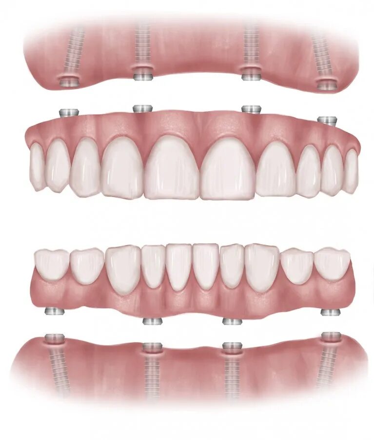 Имплантация зубов по технологии all-on-4 ("все на четырех"). Имплантация all on 4 челюсть.