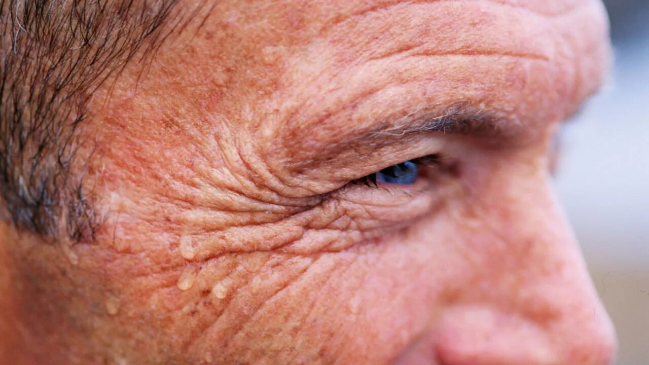 Возрастные пятна вокруг глаз. Skin wrinkles