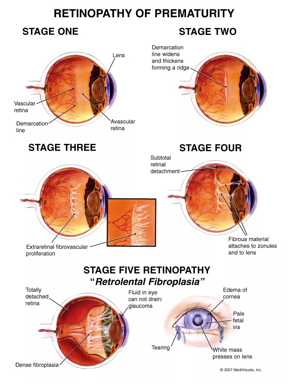 Ретинопатия 1 степени у недоношенных детей. Ретинопатия недоношенных 5 стадия. Диабетическая ретинопатия стадии. Диабетическая ретинопатия изменения глазного дна. Диагноз сетчатки