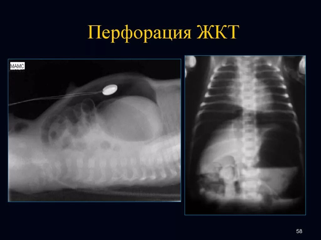 Что такое перфорация кишечника. Перфорация кишечника рентген. перфорации стенок пищеварительного тракта. прободение (перфорация) кишечника. перфорация внутренних полых органов.
