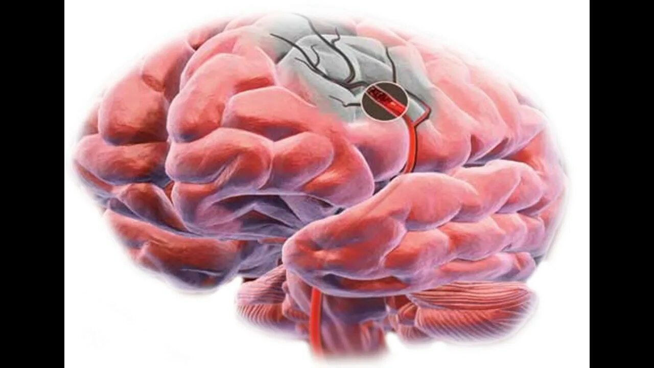 Очистка сосудов головы. Очищение сосудов головного мозга. Очищение сосудов головного мозга – уникальные методики. Mрт сосудов головного мозга. Стенд на сосуд головного мозга.