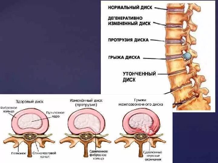 Дорзальная протрузия дисков l3-l4, l4-l5, l5-s1. Протрузиимежпощвонковыхдисковл1,л2,л3,л5,s1. Диски l2-l3 позвоночника. Задняя циркулярная протрузия диска l5-s1.