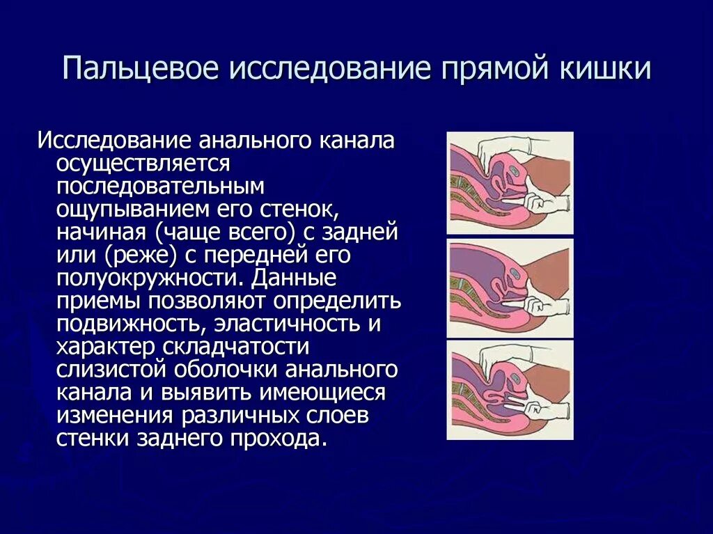 Осуществление пальцевого исследования прямой кишки. Методика пальцевого ректального исследования. Методика пальцевого обследования прямой кишки. Пальцевое исследование прямой Кишк.