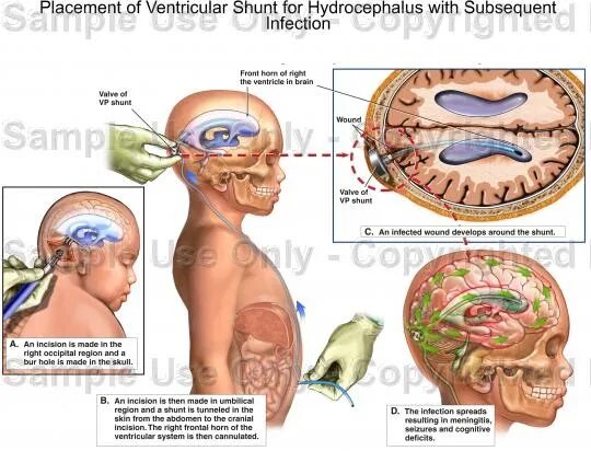 Гидроцефалия шунтирование мозга. Шунтирование гидроцефалии головного. Шунтирование гидроцефалии головного мозга. Шунтирование ликвора головного. Шунтирование гидроцефалии головного мозга ребенка.