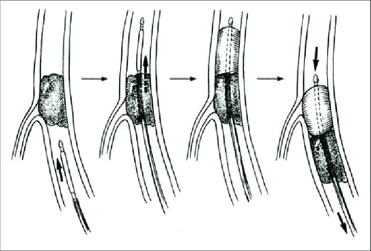 Катетер фогарти. Непрямая тромбэктомия катетером Фогарти. Непрямая эмболэктомия зондом Фогарти. Тромбэктомия катетером Фогарти.