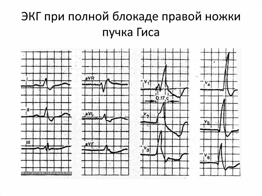 Полная блокада пучка ножки гиса лечение. Блокада левой ножки пучка Гиса на ЭКГ. Неполная блокада правой ножки пучка на ЭКГ. Блокада пучка Гиса на ЭКГ. Неполная блокада ножек пучка Гиса.