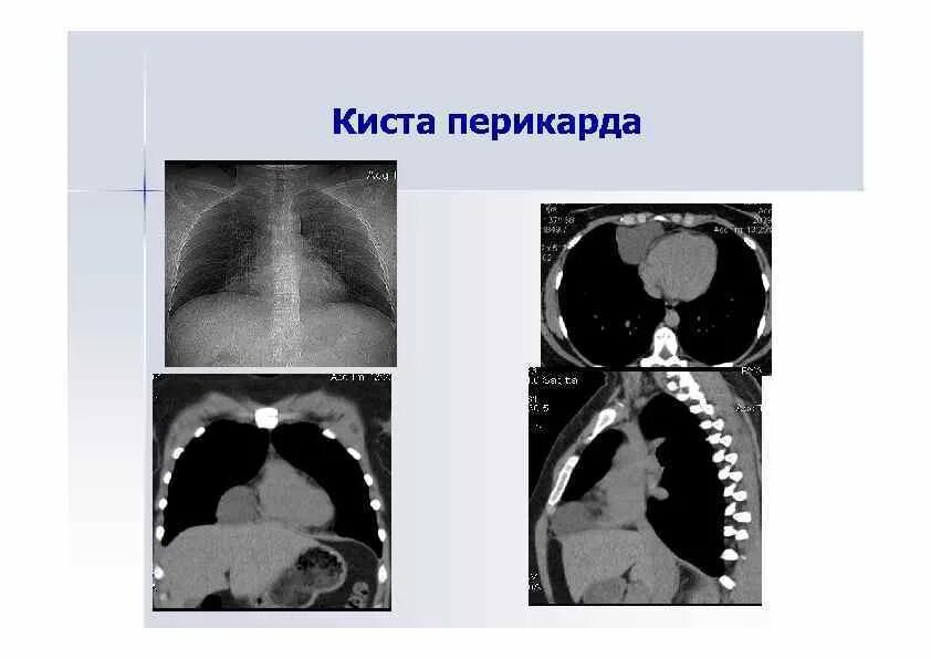 Киста перикарда рентген. Киста перикарда операция. Констриктивный перикардит рентген. Киста перикарда операция. Целомическая киста средостения рентген.