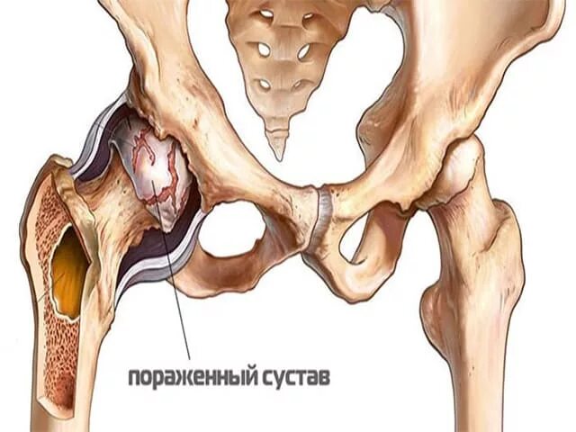 Тазобедренный артрит симптомы