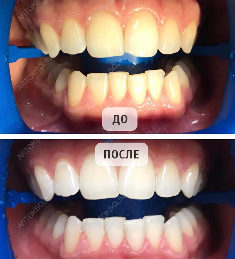 Лазерное отбеливание отзывы. Офисное отбеливание зубов. Отбеливание зубов кабинетное до и после.