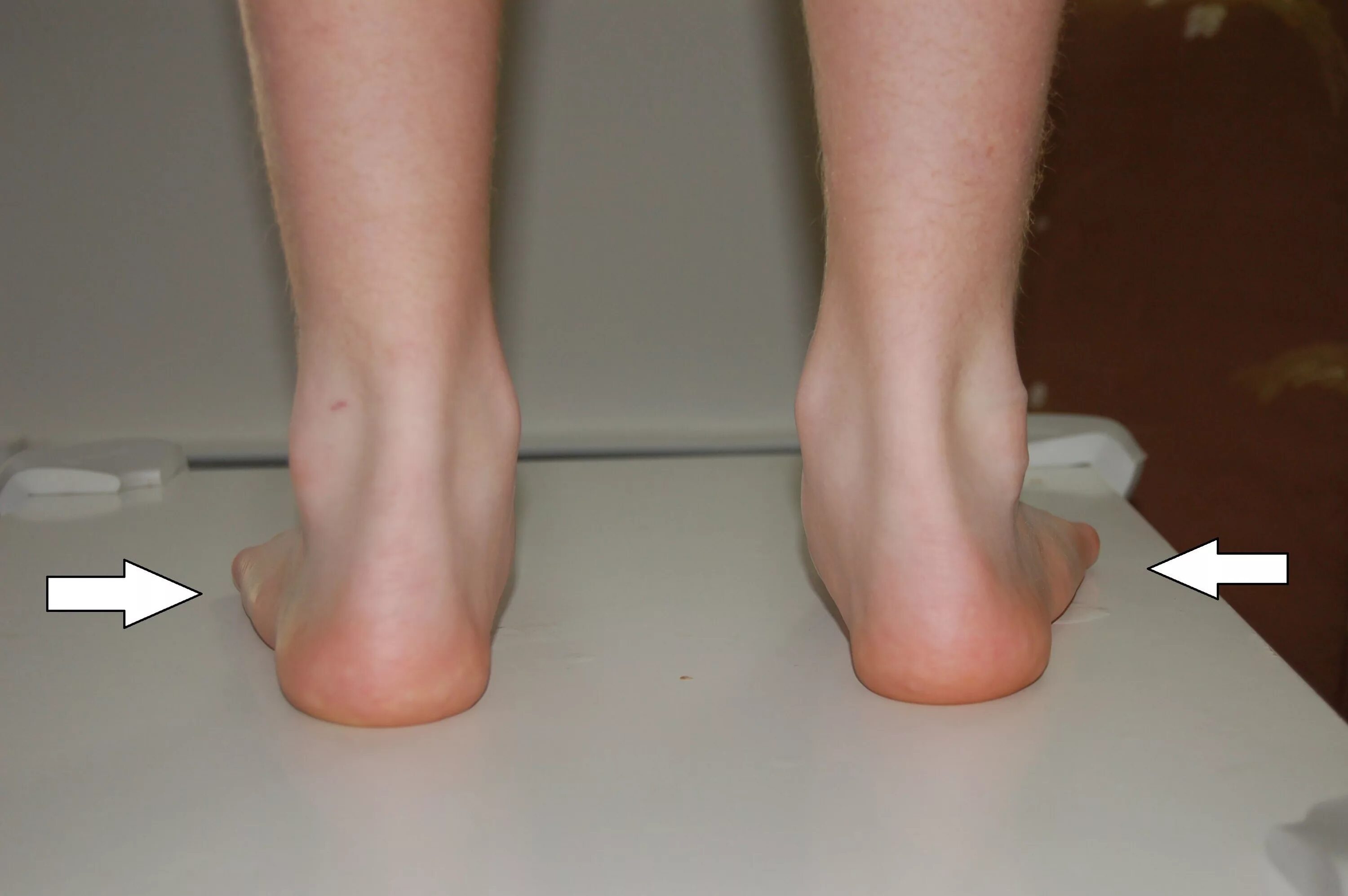 Плоскостопие на одной ноге берут ли. Вальгус плоскостопия у детей. Плоскостопие вальгусная стопа. Косолапость и плоскостопие. Вальгусная косолапость.
