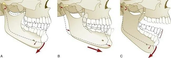 Подвижное соединение челюстей. ВНЧС движение нижней челюсти. Биомеханика движений нижней челюсти ВНЧС. Фронтальная ось движения ВНЧС.