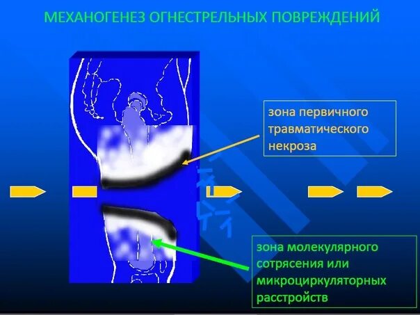 Зоны огнестрельного ранения. Зоны при пулевом ранении.