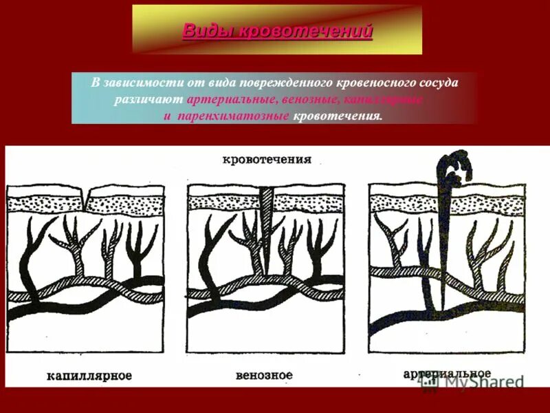 Какой сосуд поврежден. Повреждение кровеносных сосудов. Виды повреждений кровеносных сосудов. Артериальное венозное капиллярное.