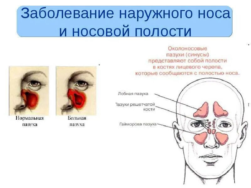 Заболевания наружного. Заболевания носа и придаточных пазух. Классификация воспалительных заболеваний околоносовых пазух.. Красные носовые пазухи снаружи. Болезни носа и околоносовых пазух.