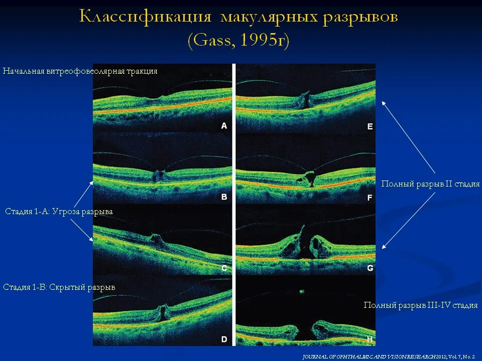 Молекулярный разрыв. Витреомакулярный тракционный синдром. Макулярный тракционный синдром. Тракционный макулярный отек. Витреомакулярный тракционный синдром глаза.