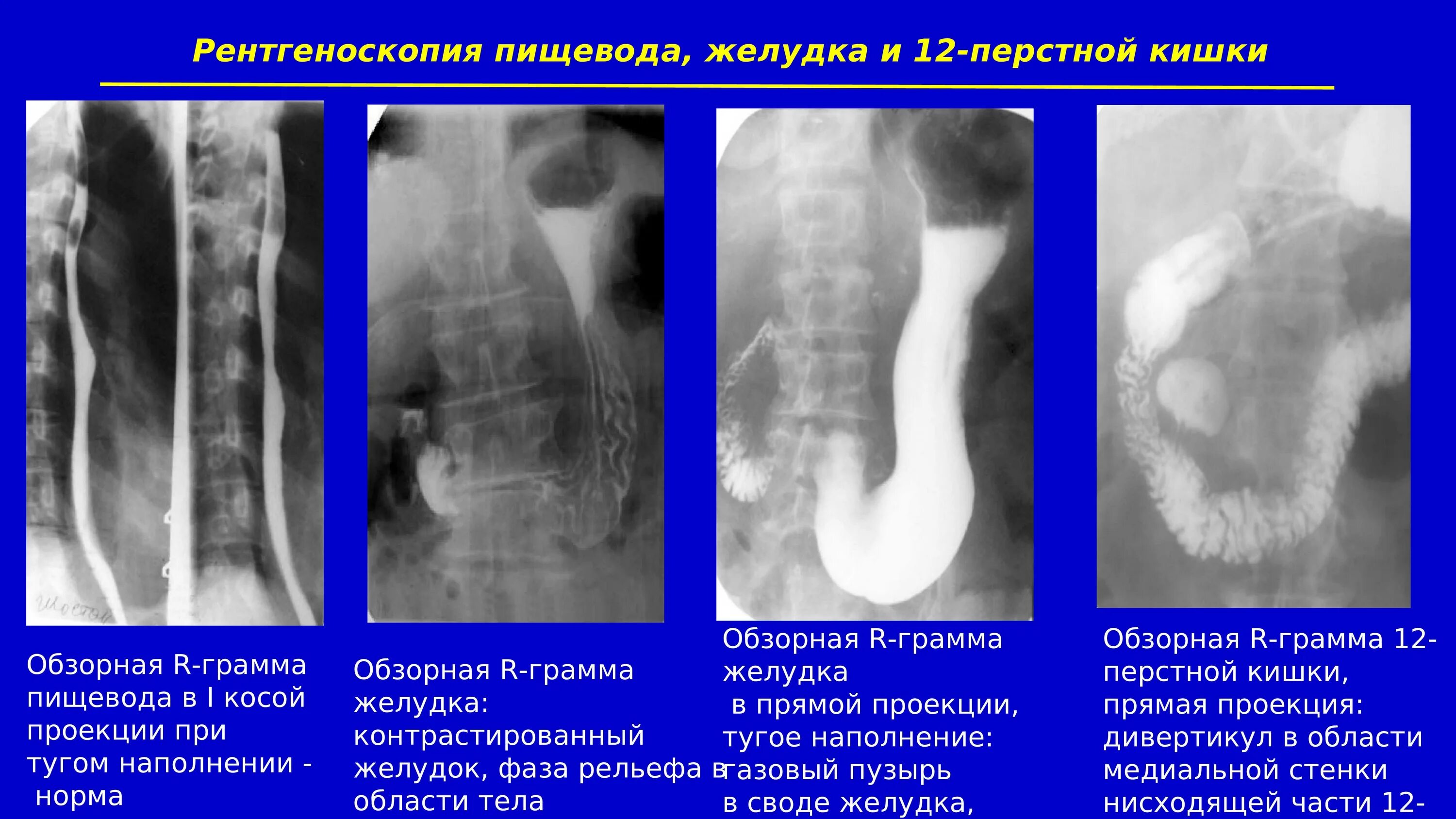 Рентгеноскопия и рентгенография желудка и 12-перстной кишки. Рентген исследования желудка и 12 перстной кишки. Рентгенологическое исследование пищевода, желудка, 12-перстной кишки.. Рентгенологическое исследование пищевода и желудка. Скопия пищевода желудка