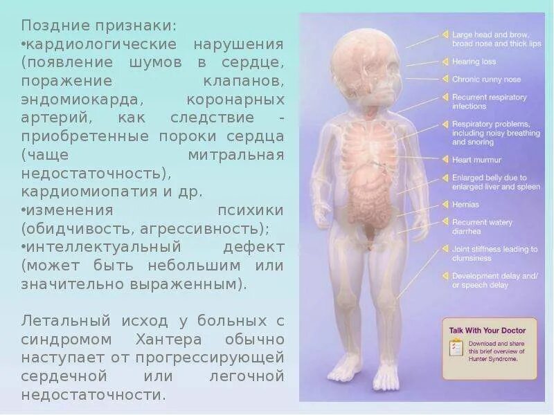 Синдром Хантера (МПС II типа). Мукополисахаридоз 2 типа синдром Хантера. Синдром Хантера признаки.