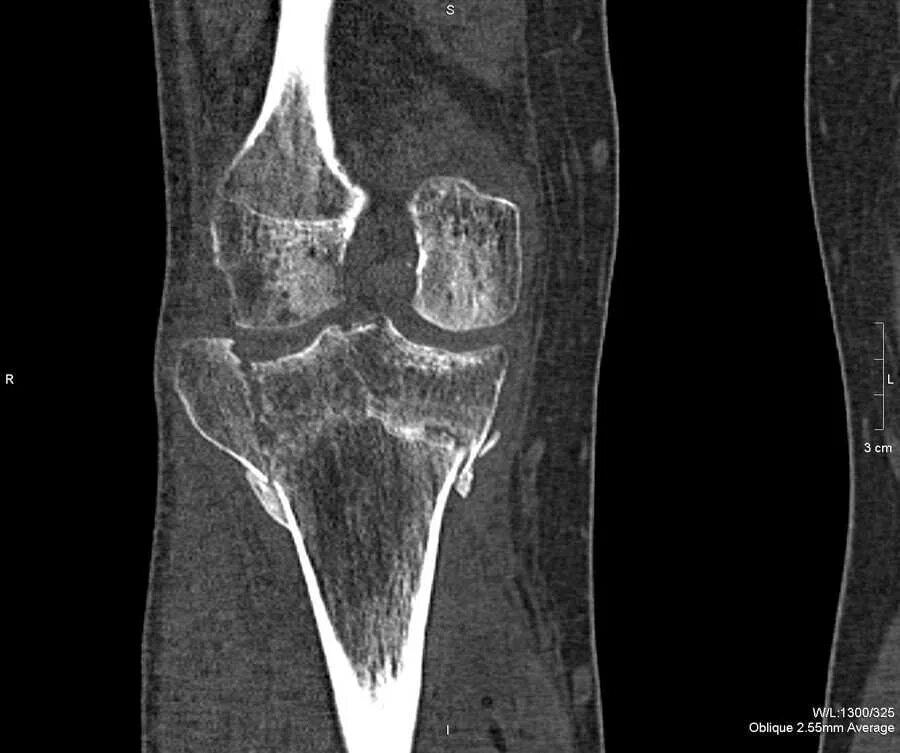 Артрит кт. Остеомиелит коленного сустава мрт. Кт снимок коленного сустава. Остеомиелит коленного сустава кт.