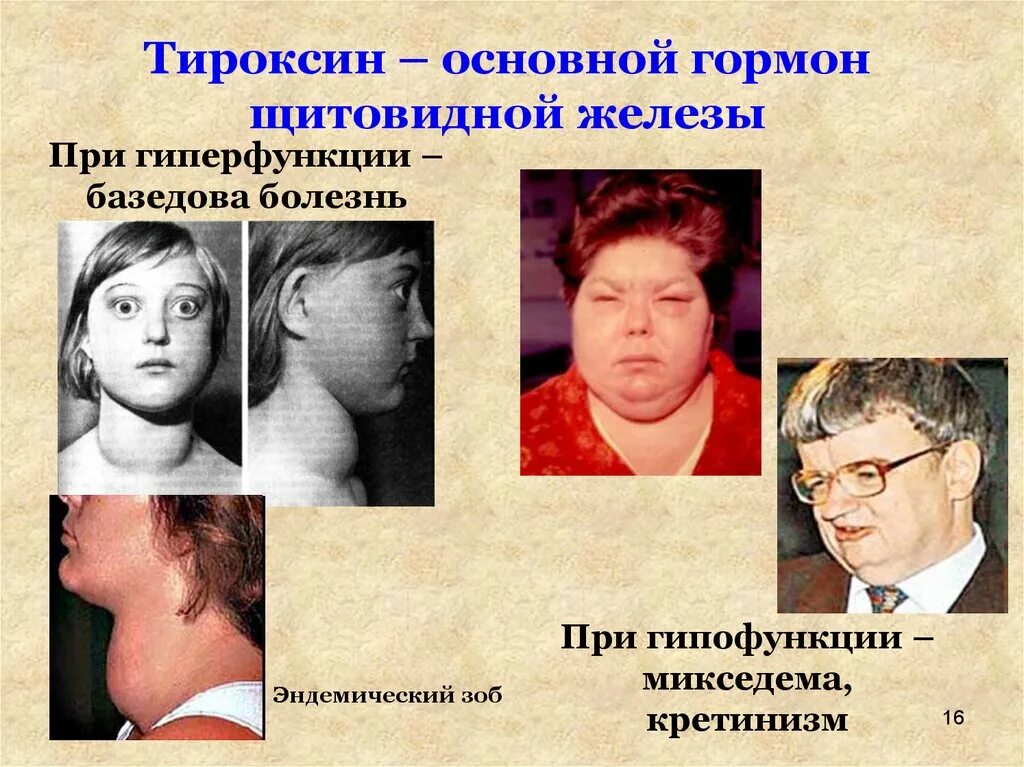 Недостаток гормонов вызывает. Гиперфункция гормона тироксина. заболевание при недостатке тироксина. заболевания при недостатке гормонов щитовидной железы. тироксин избыток и недостаток.