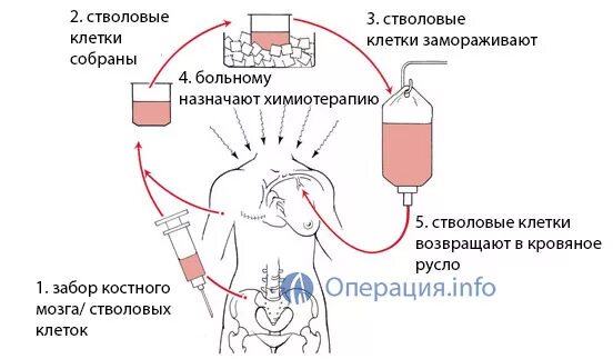 Пересадка клеток мозга. Физиологические основы пересадки костного мозга.. Пересадка стволовых клеток. Трансплантация стволовых клеток. Трансплантация клеток костного мозга.