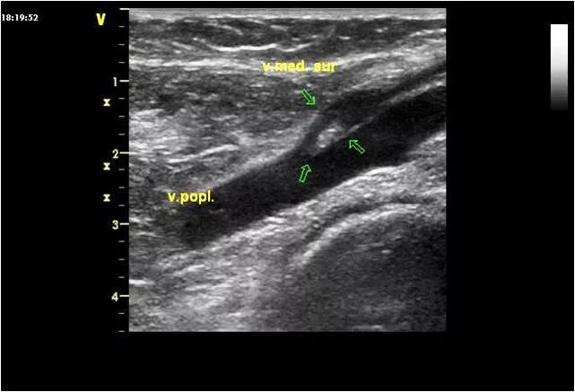 Тромбоз подколенной вены на УЗИ. Тромбоз подколенной артерии УЗИ. Малая подкожная Вена на УЗИ. Тромбоз бедренной вены на УЗИ. Узи вен тромбоз