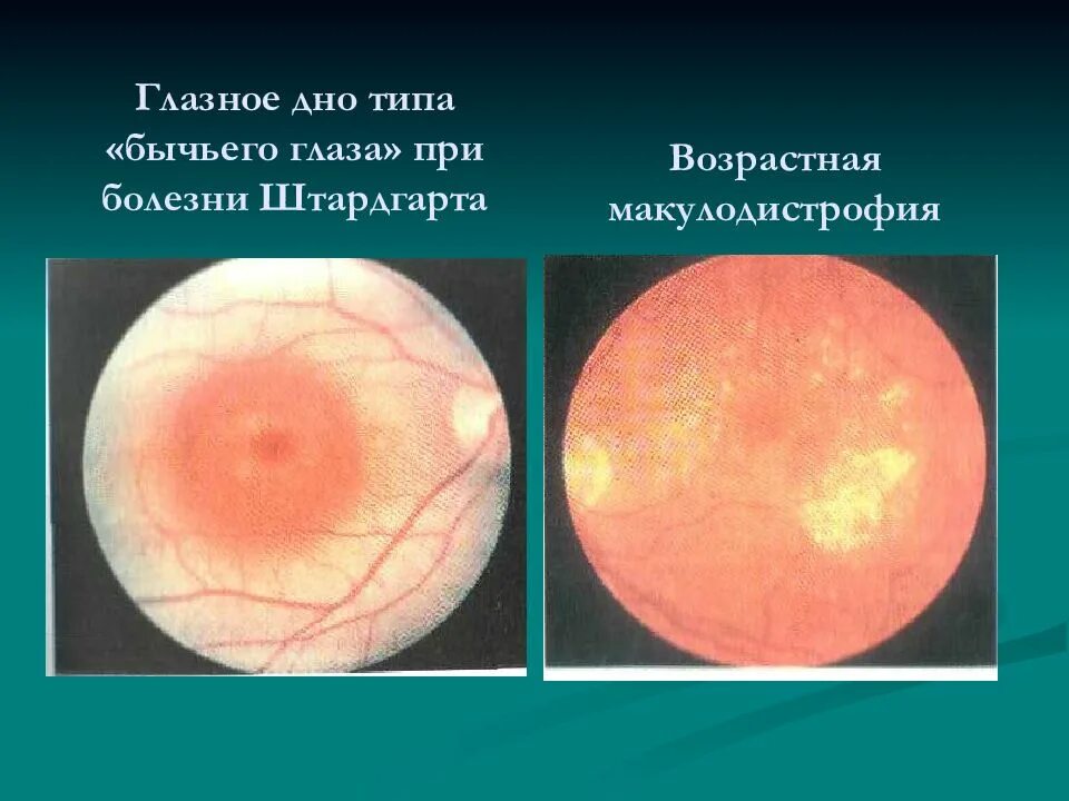 Макулопатия бычий глаз. Макулодистрофия штаргардта глазное дно. Болезнь штаргардта глазное дно. Макулопатия глаза