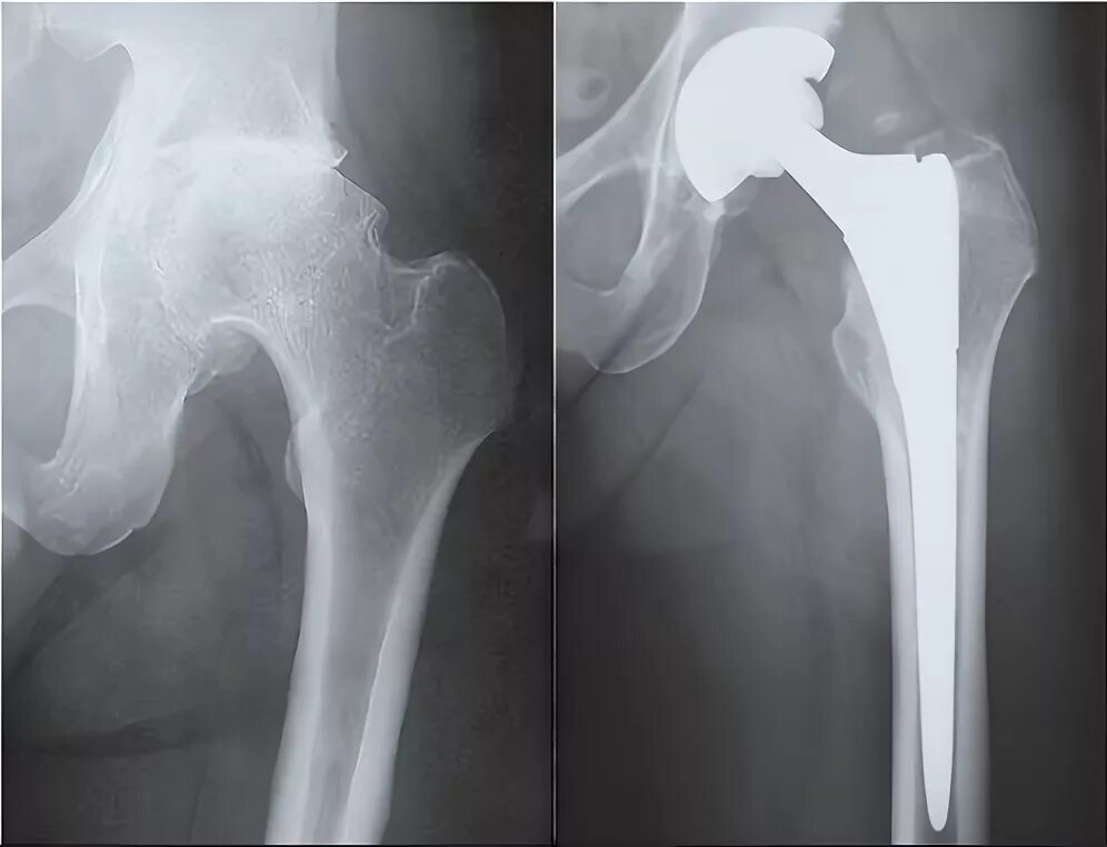 Эндопротезирование тазобедренного сустава. Анкилоз тазобедренного сустава и инвалидность. Рентгены тазобедренных эндопротезов. Эндопротезирование двух тазобедренных суставов.