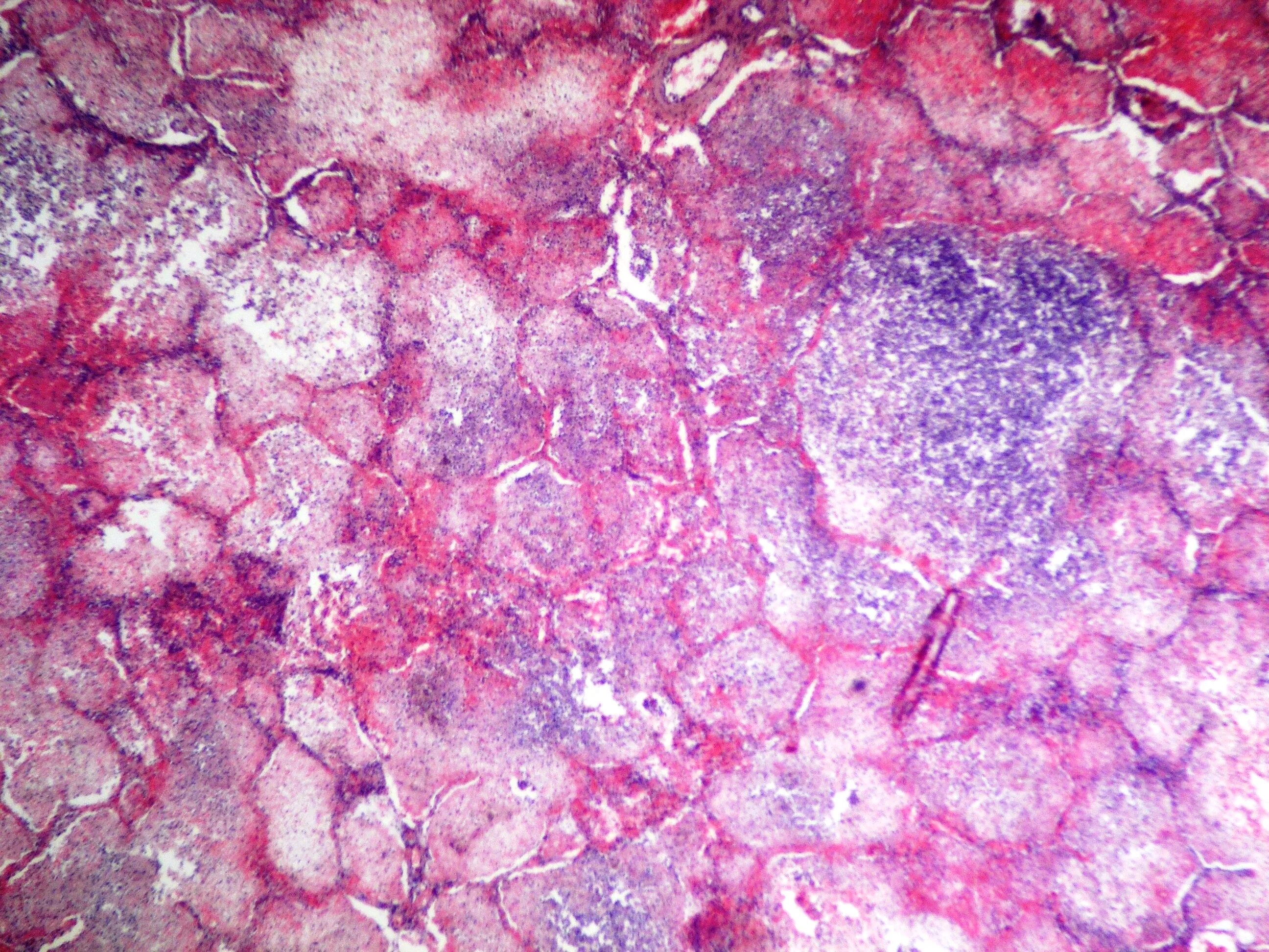 серозно геморрагическая пневмония. легкое при гриппе макропрепарат. гриппозная пневмония препарат патанатомия. очаговая пневмомния микро. большое пестрое гриппозное легкое макропрепарат.