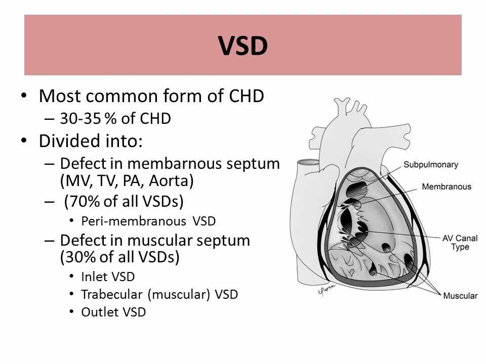 Common form. Ventricular Septal defect VSD. Inlet VSD. Vsdvs. Postinfarction ventricular Septal defect.