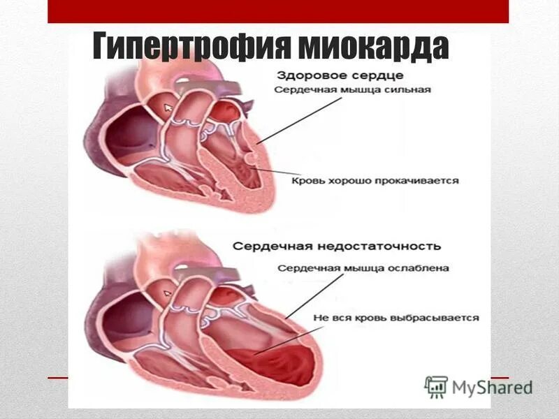 Гипертрофия что это. Физиологическая гипертрофия миокарда. Патологическая гипертрофия миокарда. Гипертрофия сердечной мышцы.