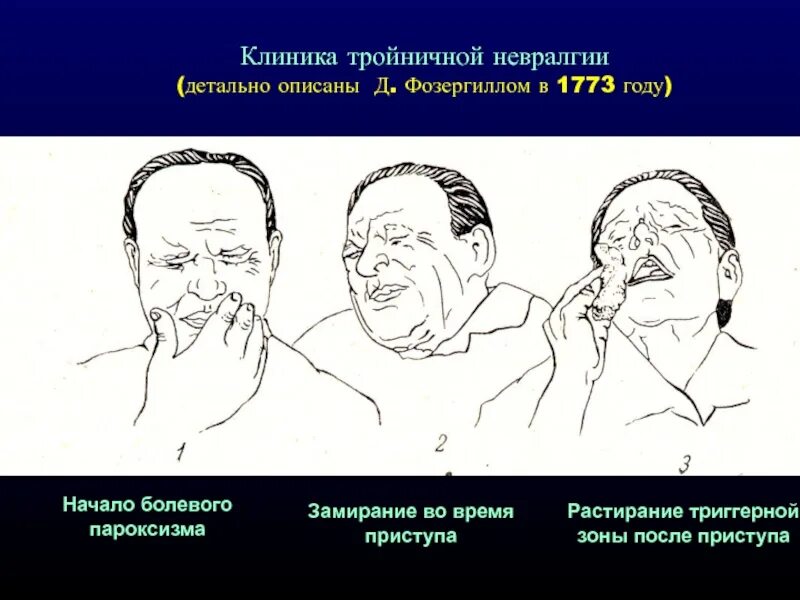 Клиника невралгии тройничного. Оперкулярные пароксизмы. Оперкулярные припадки. Церебральный пароксизм.