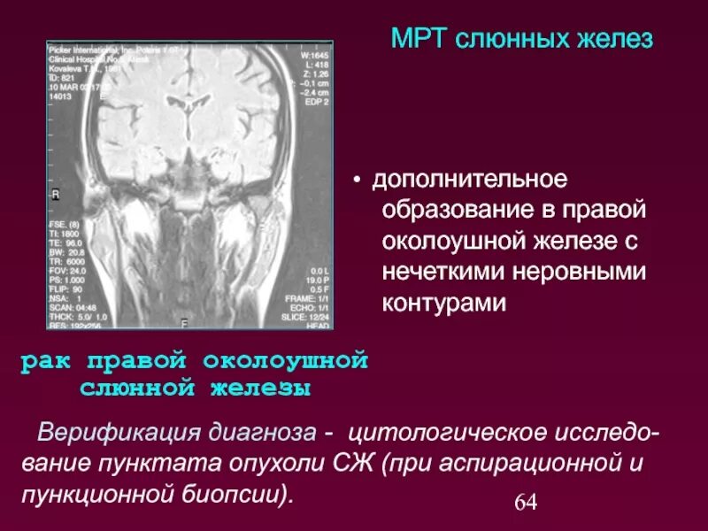 Образование околоушных желез. Киста околоушной железы мрт. Опухоль слюнной железы на мрт. Образование околоушной слюнной железы мрт. Опухоли околоушной железы мрт.