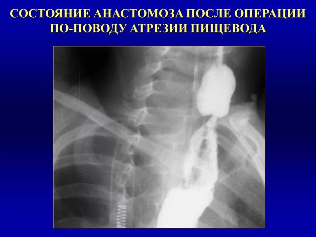 Пищевод у новорожденного. Атрезия пищевода операция. Пороки развития пищевода у детей. Атрезия пищевода рентген. Атрезия пищевода детская хирургия.