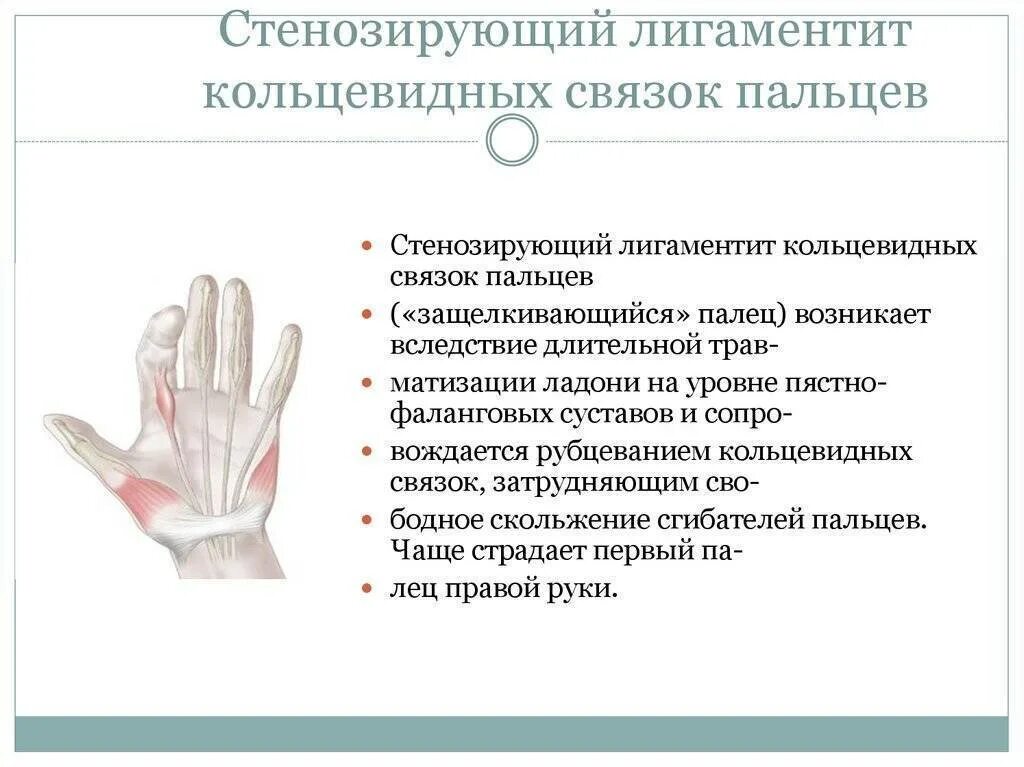 Болезнь нотта форум. Кольцевидные связки 1 пальца кисти. болезнь нотта или стенозирующий лигаментит. болезнь нотт,стенозируюший ленго. болезнь нотта большого пальца кисти.