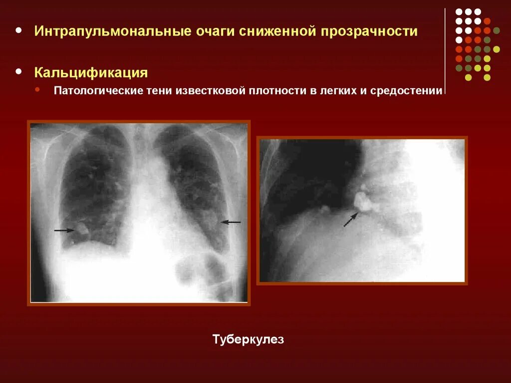 Лучевые заболевания легких. Патологические тени в легких. Рентгенодиагностика заболеваний легких. Воздушная киста средостения.