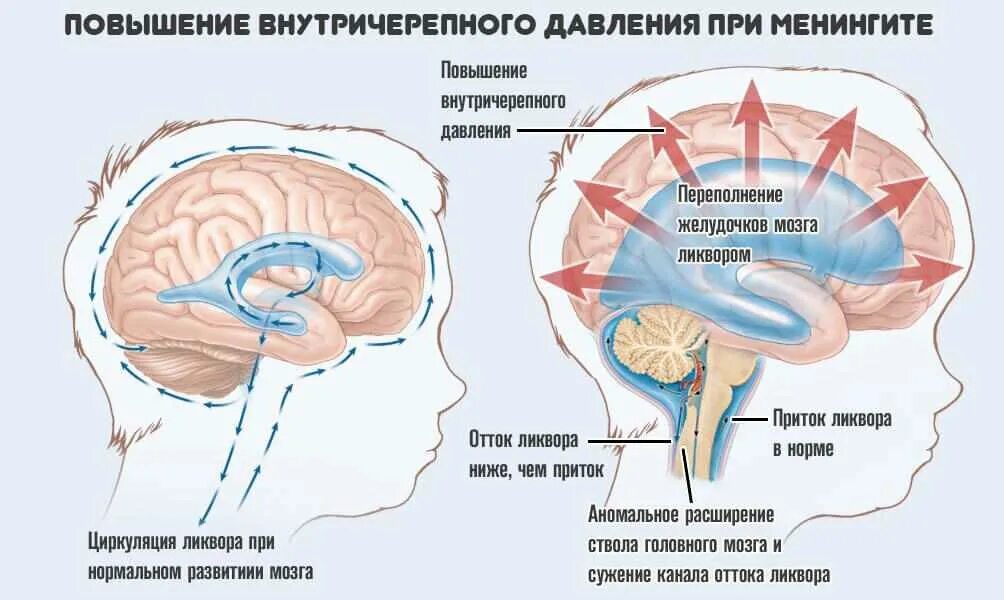 Повышено черепное давление
