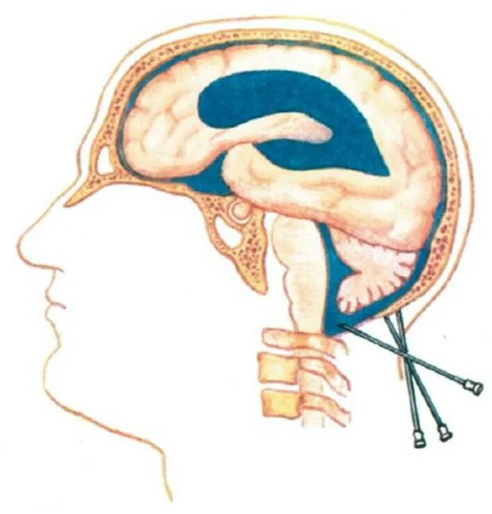 Как делают пункцию мозга. Субокципитальная пункция желудочков мозга. Цистернальная пункция. Пункция вентрикулярная люмбальная субокципитальная. Пункция мозжечково-мозговой цистерны.