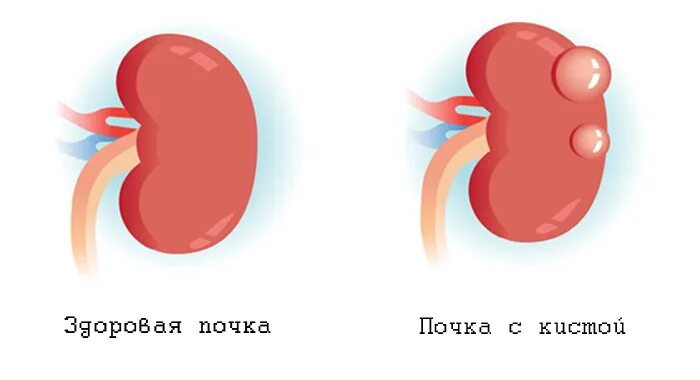 Киста в почке лечение у взрослых женщин. Киса в пачке. Косты почек.