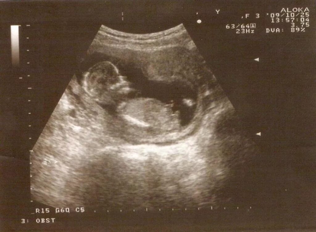 Крови 15 недель. УЗИ ребенка на 15 неделе беременности фото плода. УЗИ плода 15 акушерских недель беременности. Плод ребенка на 15 неделе беременности. Плод 15 недель беременности размер плода.