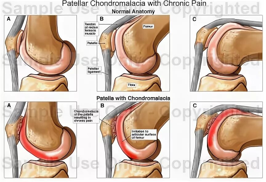 Хондромаляция 3 степени коленного сустава. Хондромаляция надколенника. Хондромаляция коленного сустава что это. Хондромаляция надколенника 4.