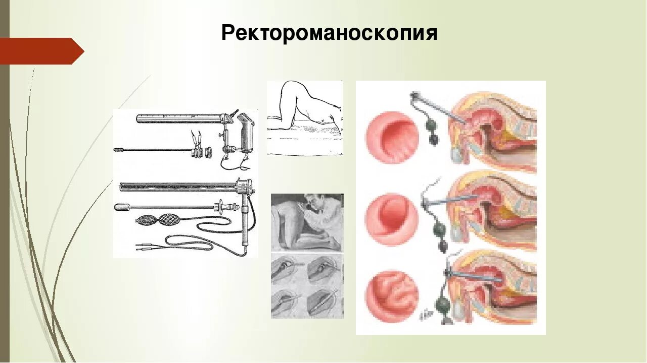 Исследование прямой и сигмовидной кишки. Обследование толстой кишки ректороманоскопия. Ректороманоскопия это метод исследования. Прямая кишка ректороманоскопия. Исследование прямой кишки ректоскопия.