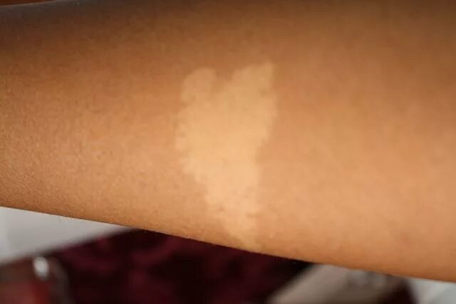 Tinea versicolor - Wikipedia