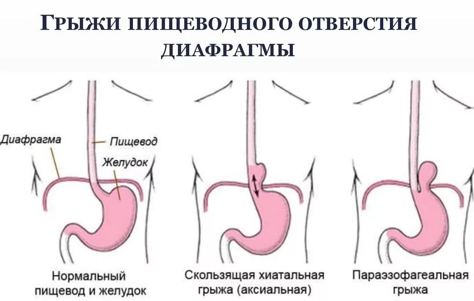 Грыжа пищевода признаки симптомы. Аксиальная скользящая грыжа пищеводного отверстия. Фундальная грыжа пищеводного отверстия. Парастернальная грыжа диафрагмы. Скользящая аксиальная грыжа пищеводного отверстия 2 степени.