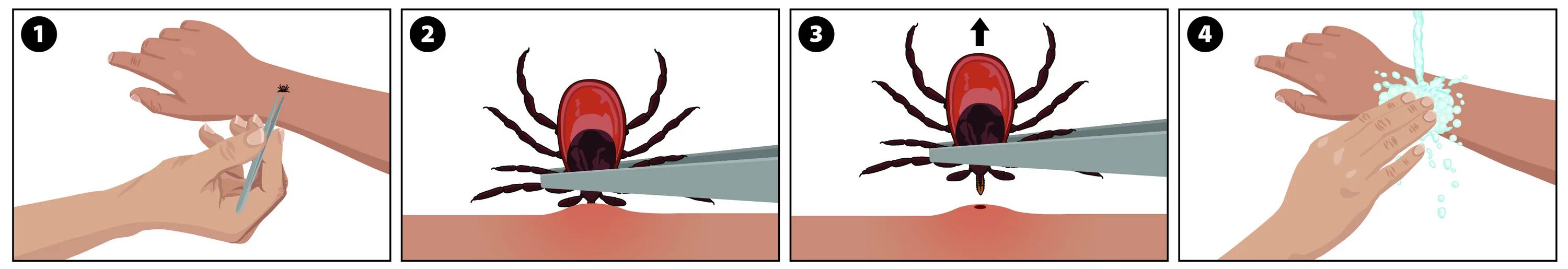 Чем обработать место после удаления клеща. Как достать клеща из кожи. Как достать впившегося клеща. Вытащить клеща присосавшегося.