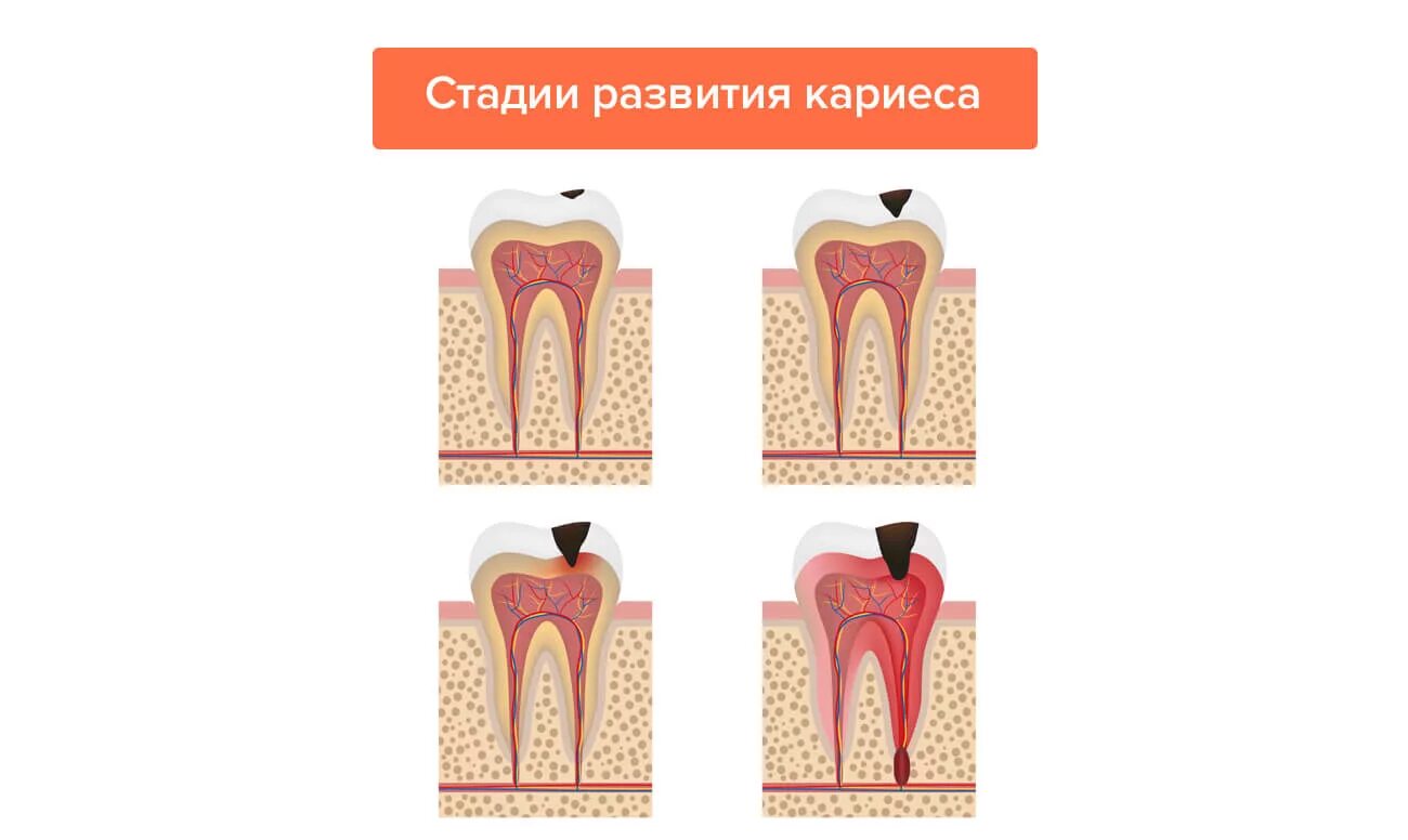 Сколько развивается кариес
